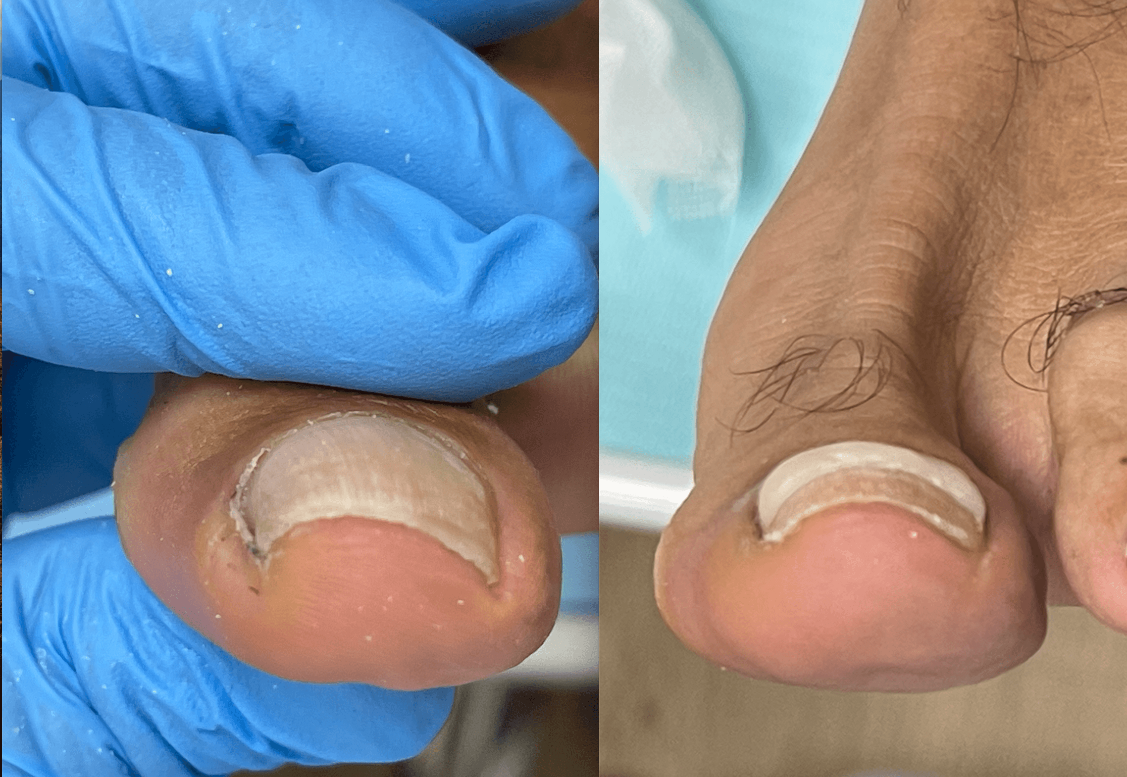 Antes y después ortonixia Onyfix tras un mes de tratamiento en Podología & Biomecánica Rivas