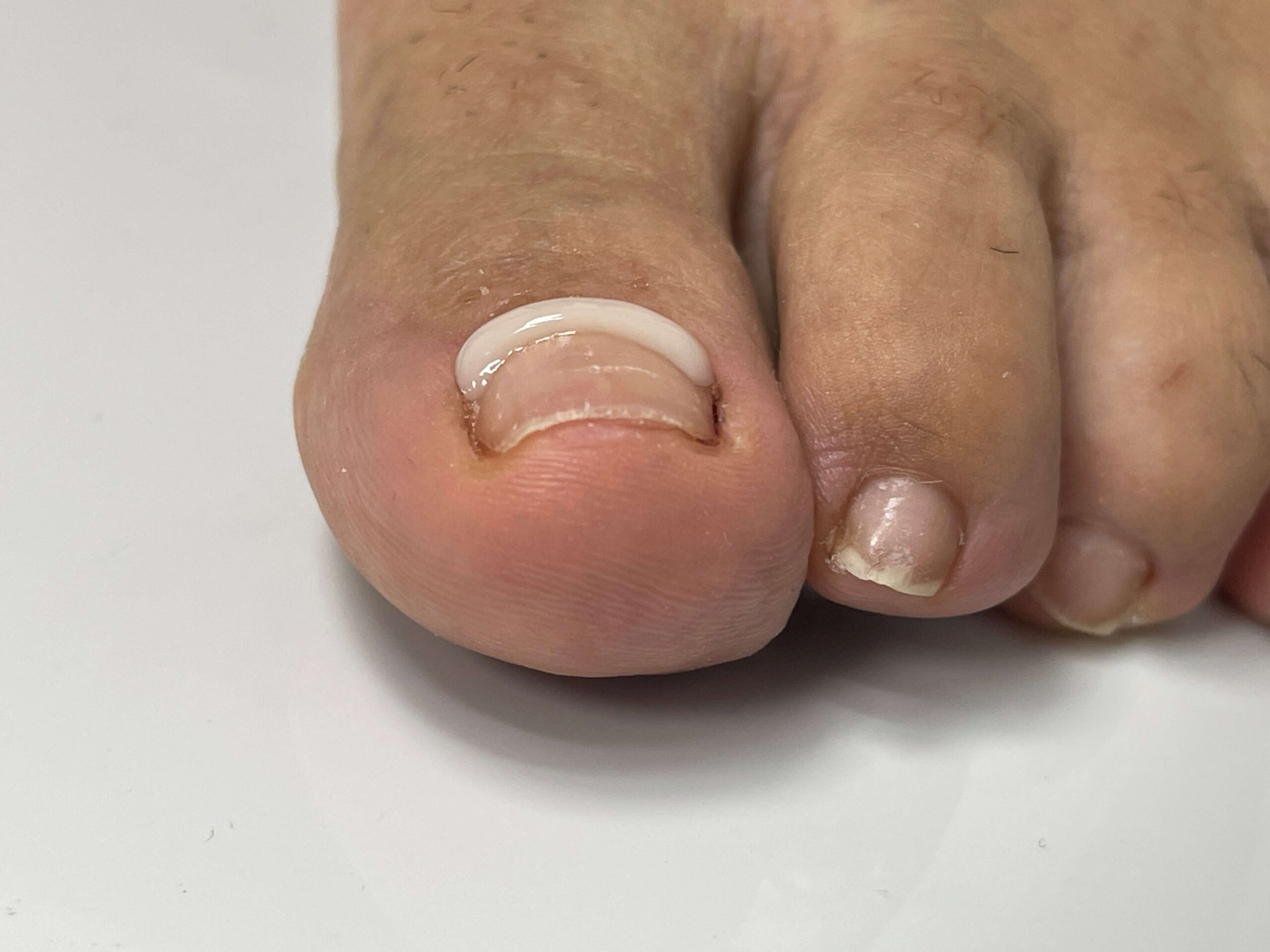 Sistema Onyfix aplicado en Podología & Biomecánica Rivas